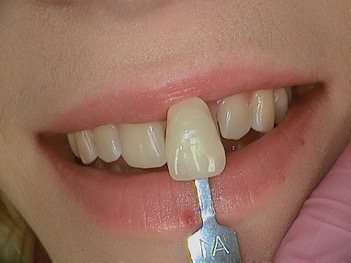 Before Veneers