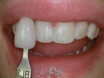 After Veneers