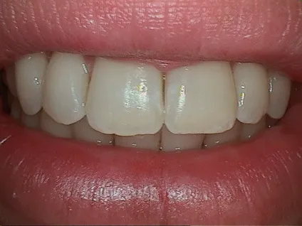Before Veneers