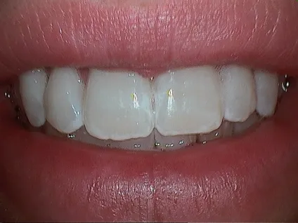 After Veneers