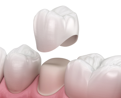 Dental Crowns