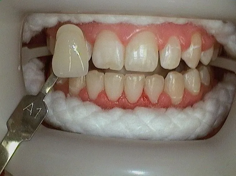 Before Veneers