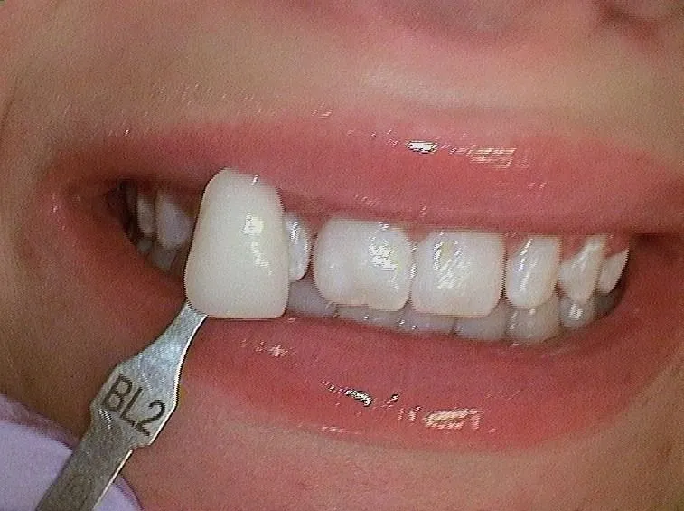 After Veneers