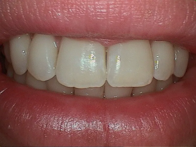 Before Veneers