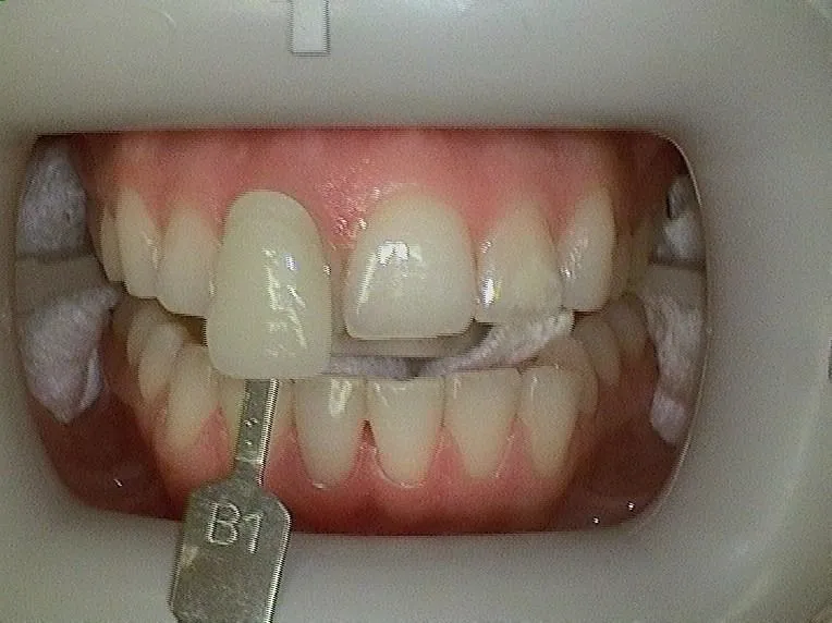 Before Veneers