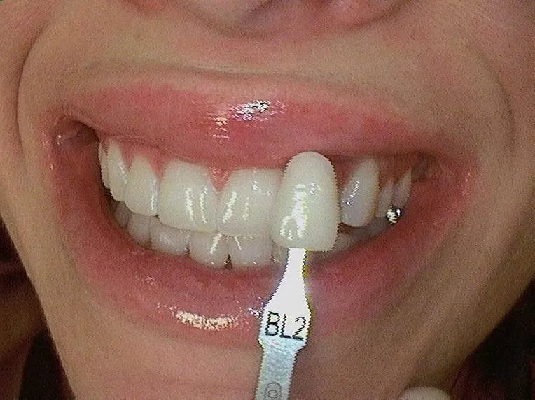 After Veneers